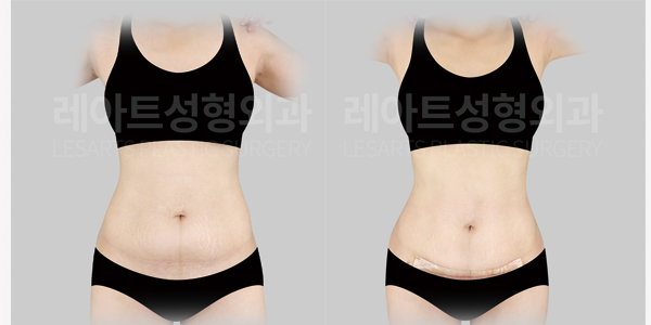 abdominoplasty_01_thumbnail_250512