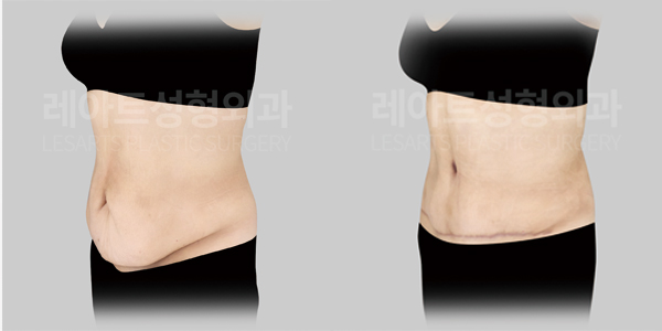 abdominoplasty_01_thumbnail_250519