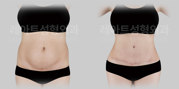 abdominoplasty_01_thumbnail_250522