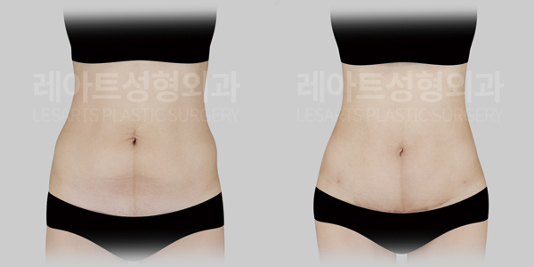 abdominoplasty_01_thumbnail_250610