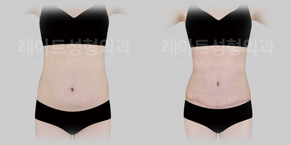 abdominoplasty_01_thumbnail_250616