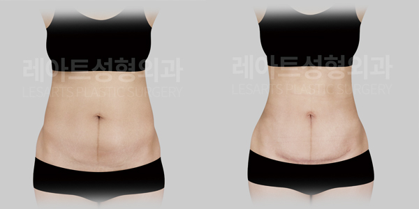 abdominoplasty_01_thumbnail_250620