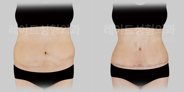 abdominoplasty_01_thumbnail_250630