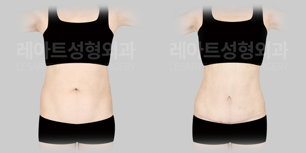 abdominoplasty_01_thumbnail_250707