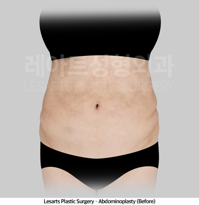 abdominoplasty_02_01_250507