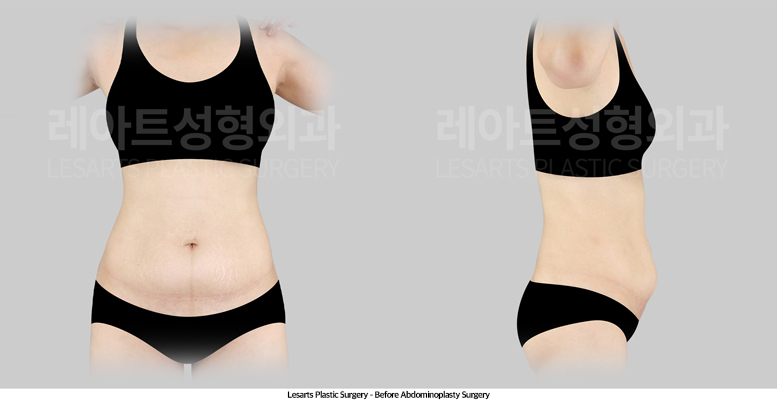 abdominoplasty_02_01_250512
