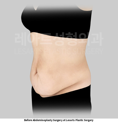 abdominoplasty_02_01_250519