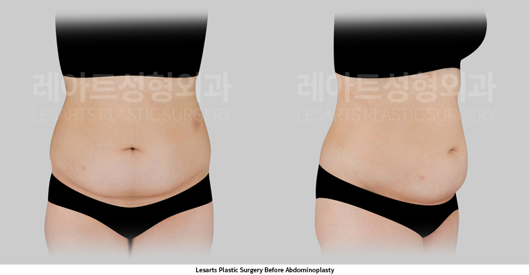 abdominoplasty_02_01_250602