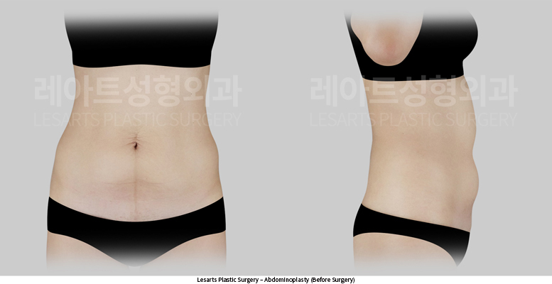abdominoplasty_02_01_250610