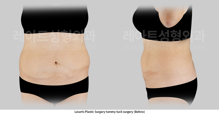abdominoplasty_02_01_250630