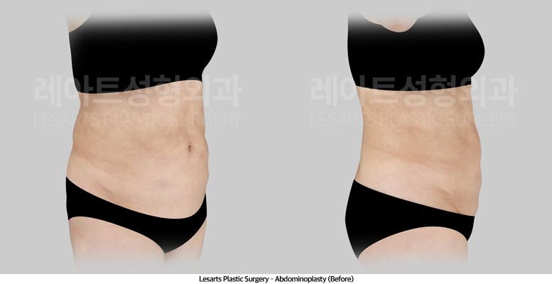abdominoplasty_02_02_250507