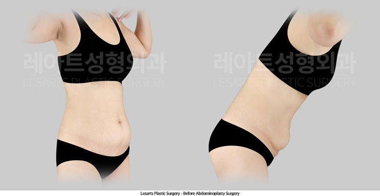 abdominoplasty_02_02_250512