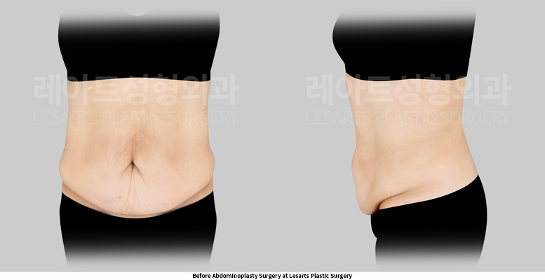 abdominoplasty_02_02_250519