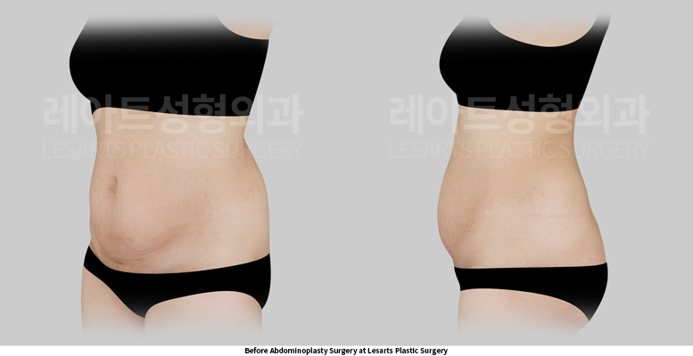 abdominoplasty_02_02_250522