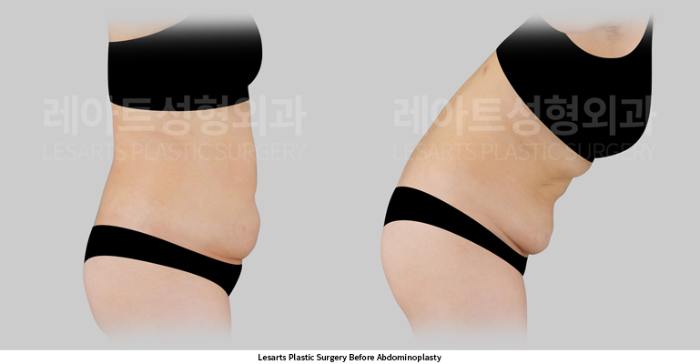 abdominoplasty_02_02_250602