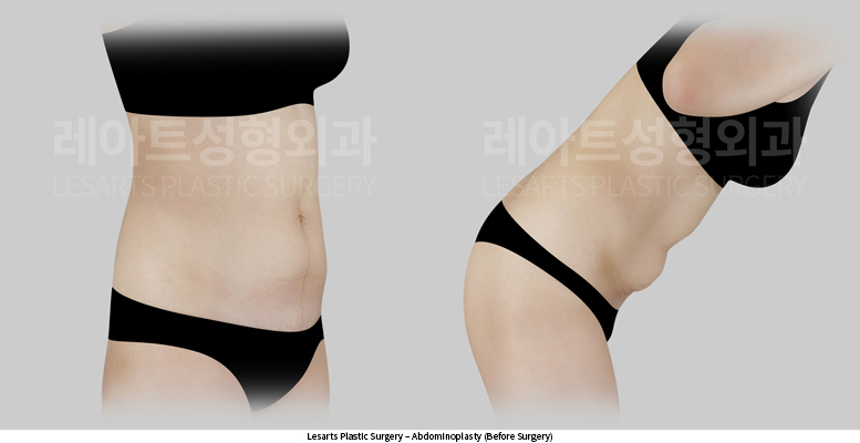 abdominoplasty_02_02_250610