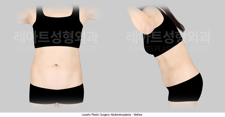 abdominoplasty_02_02_250707