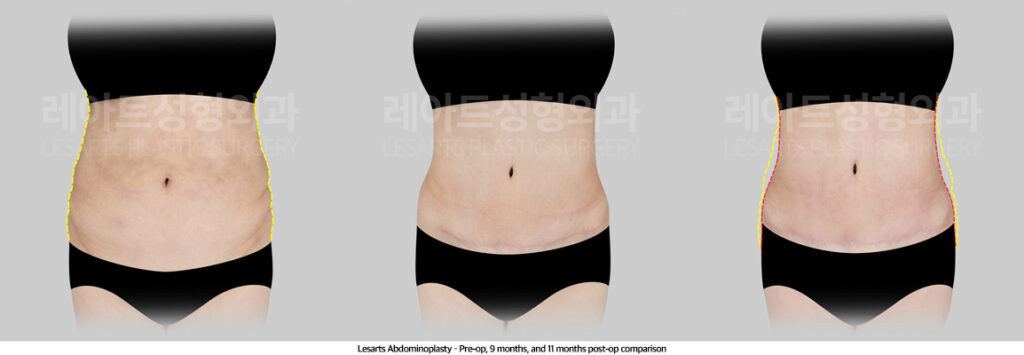 abdominoplasty_02_03_250507
