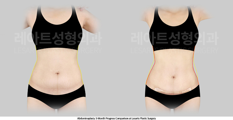 abdominoplasty_02_03_250512