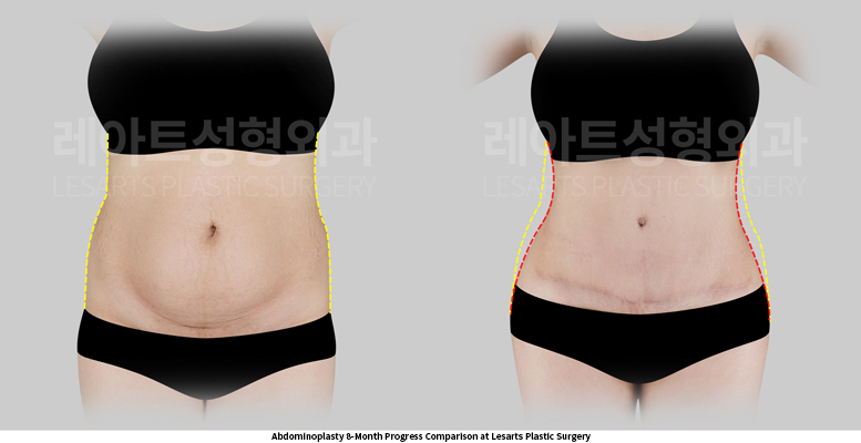 abdominoplasty_02_03_250522
