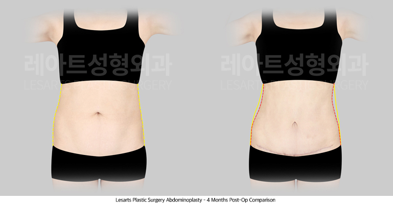 abdominoplasty_02_03_250707