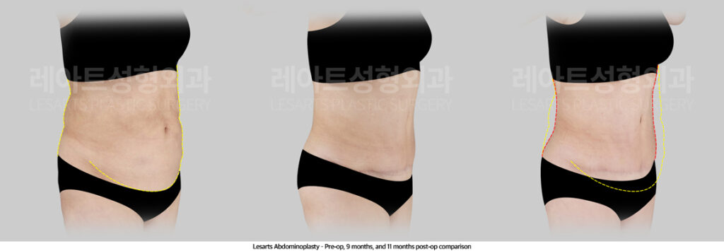 abdominoplasty_02_04_250507