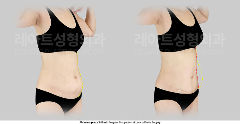 abdominoplasty_02_04_250512