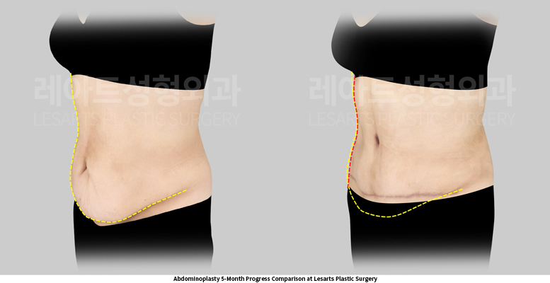 abdominoplasty_02_04_250519