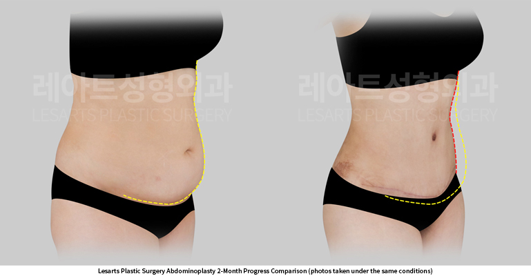 abdominoplasty_02_04_250602