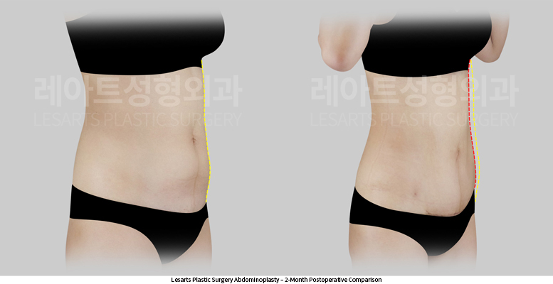 abdominoplasty_02_04_250610