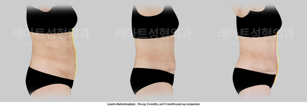 abdominoplasty_02_05_250507