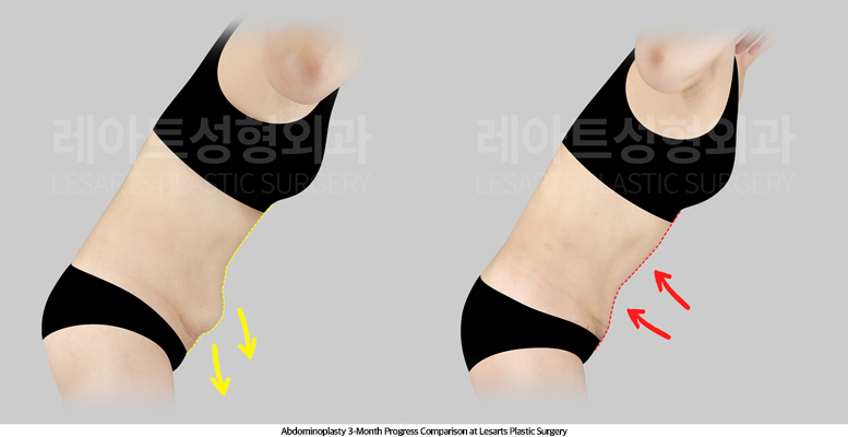 abdominoplasty_02_05_250512