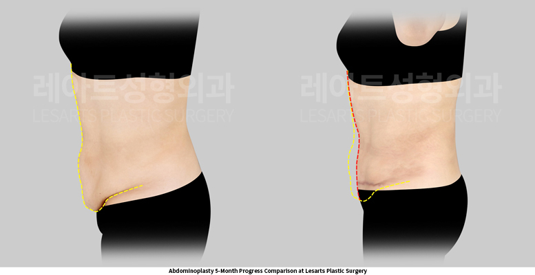 abdominoplasty_02_05_250519