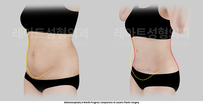 abdominoplasty_02_05_250522