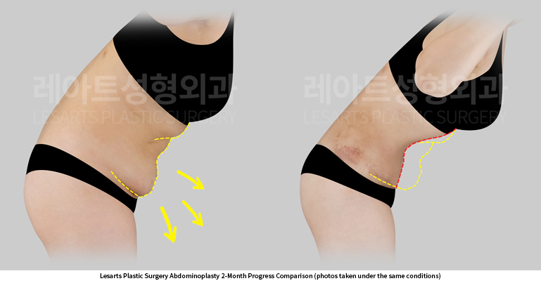 abdominoplasty_02_05_250602