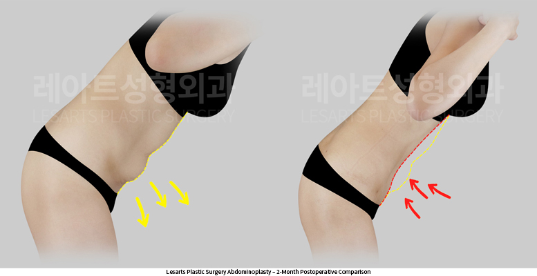 abdominoplasty_02_05_250610