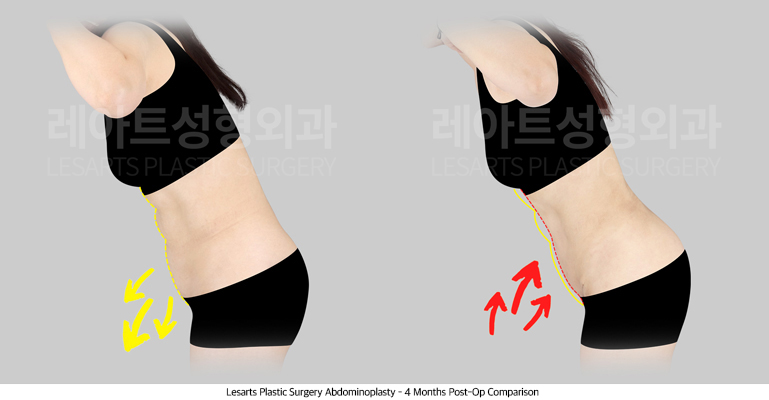 abdominoplasty_02_05_250707