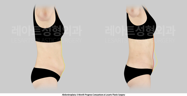 abdominoplasty_02_06_250512