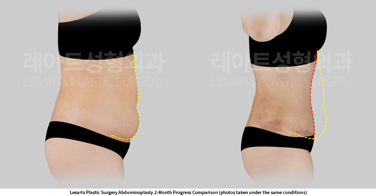 abdominoplasty_02_06_250602