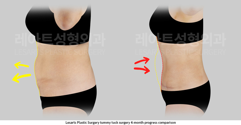 abdominoplasty_02_06_250630