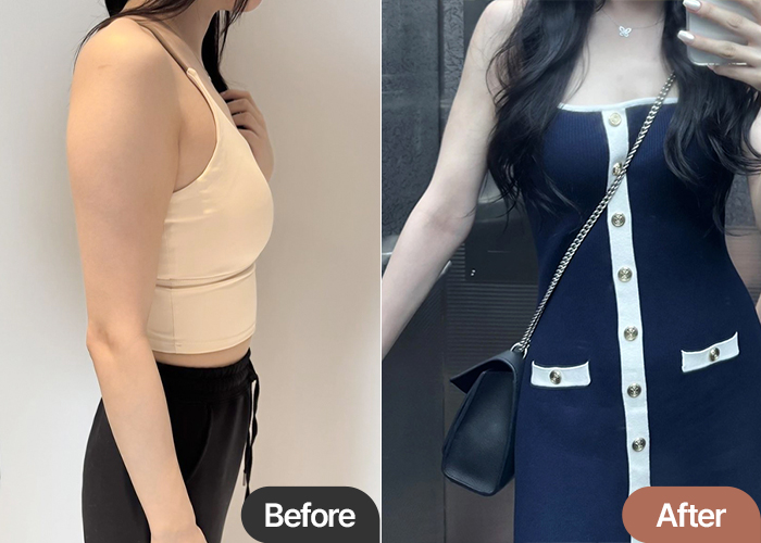 Arm Liposuction 9-Month Review in Korea – Proven Results by Kkulnyangnyang at Lesarts Plastic Surgery