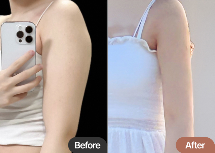 Nyeoeongha arm liposuction with accessory breast before & after in Korea – Best Liposuction Clinic in Gangnam Lesarts