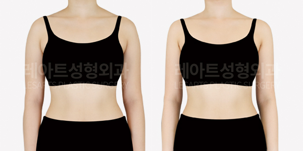 arm_liposuction_01_thumbnail_250610