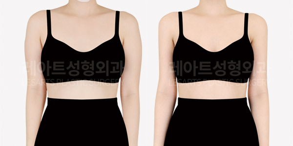 arm_liposuction_01_thumbnail_250701