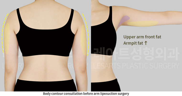arm_liposuction_02_02_250610