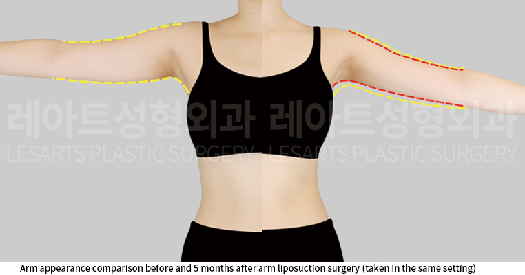 arm_liposuction_02_06_250610