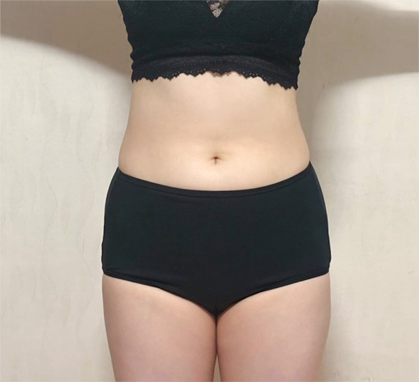 Haengbogi34 abdominal liposuction before photo in Korea – Lesarts Plastic Surgery