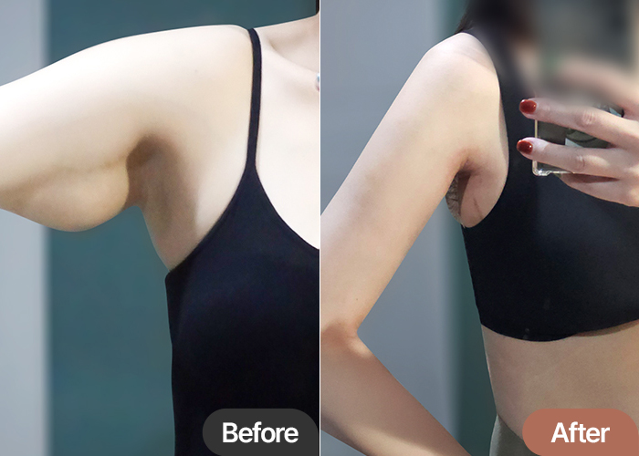 Brachioplasty(arm lift) & Arm Liposuction  1.5-Month Review in Korea – Real Recovery at Lesarts Plastic Surgery