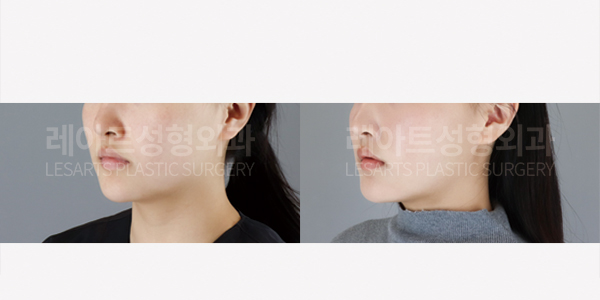facial_liposuction_01_thumbnail_250626