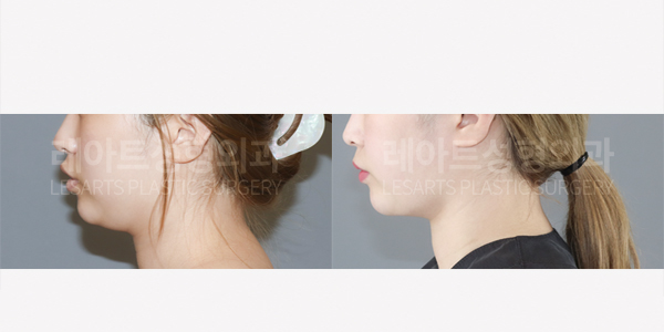 facial_liposuction_01_thumbnail_250703
